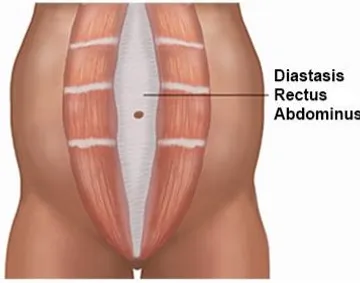 A diagram showing the anatomy of a rectus abdominis.