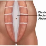 How to Test the Separation in your Abs! (Diastasis Rectus Abdominis)